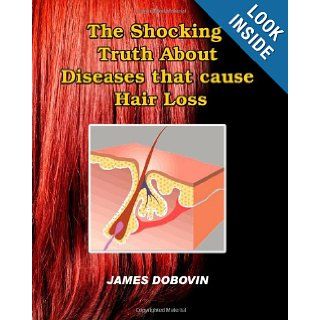 The Shocking Truth About Diseases that Cause Hair Loss: Secrets You Need to Know About Losing Hair So You Can Stop From Going Bald: James Dobovin: 9781451518788: Books