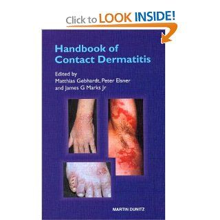 Handbook of Contact Dermatitis (9781841842271): Matthias Gebhardt, Peter Elsner, James G. Marks: Books